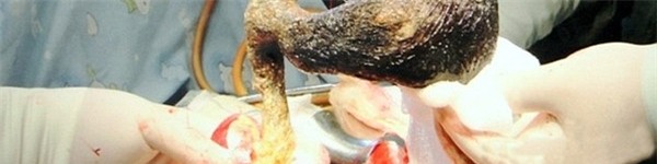 Phát hiện cuộn tóc rối to 10cm trong bụng bé gái 7 tuổi