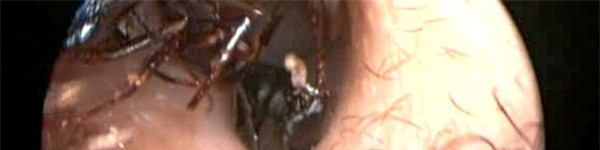 Kinh hãi hàng nghìn con kiến làm tổ trong lỗ tai bé gái 12 tuổi