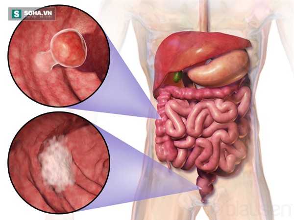 19 tuổi đã ung thư giai đoạn cuối: Bài học cảnh tỉnh bất kỳ ai - Ảnh 1.