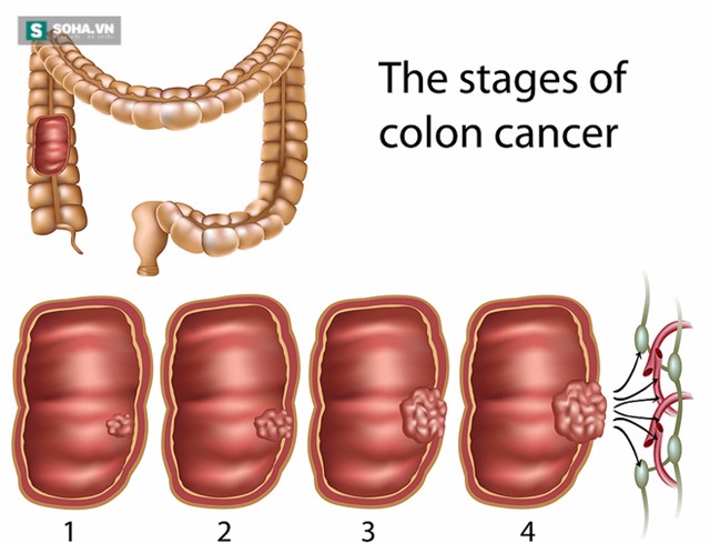 19 tuổi đã ung thư giai đoạn cuối: Bài học cảnh tỉnh bất kỳ ai - Ảnh 2.