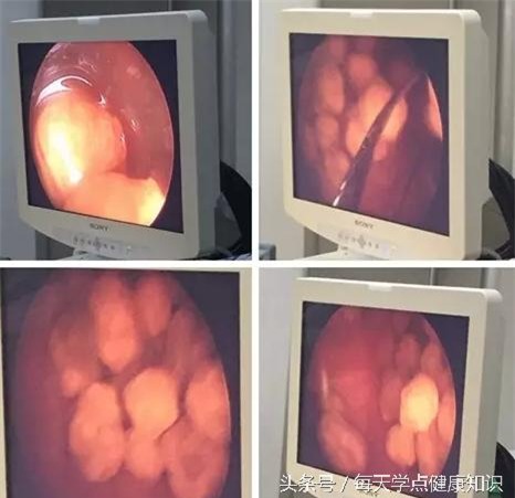 Bé gái có 25 viên sỏi mật chỉ vì thói quen ăn vặt ở cổng trường - Ảnh 2.