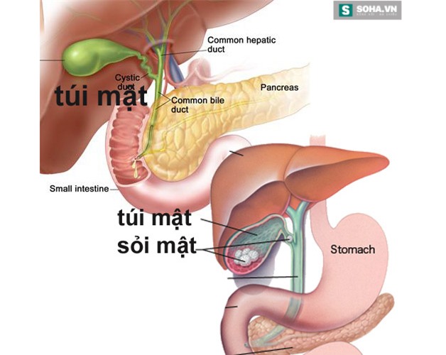 Bé gái có 25 viên sỏi mật chỉ vì thói quen ăn vặt ở cổng trường - Ảnh 4.