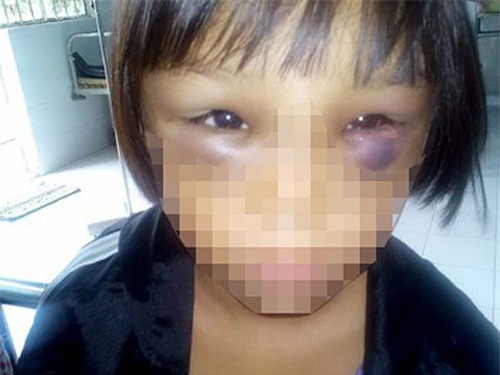 Sức khỏe bé gái 7 tuổi nghi bị mẹ kế bạo hành đã tốt hơn - 1