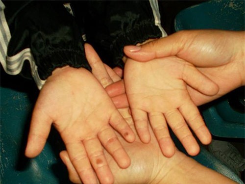 Sức khỏe bé gái 7 tuổi nghi bị mẹ kế bạo hành đã tốt hơn - 2