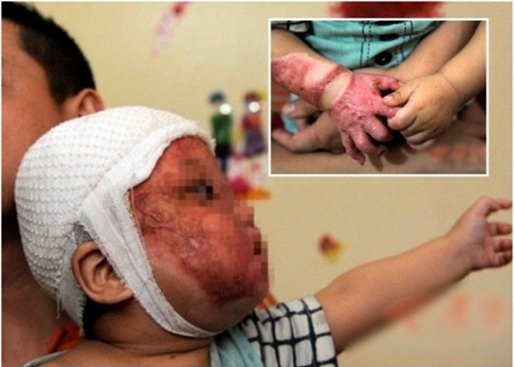 Xót xa bé 1 tuổi bị bỏng nặng vì ngã vào nồi nước nóng 3