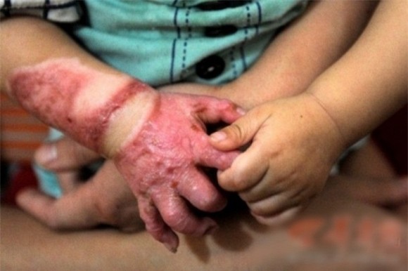 Xót xa bé 1 tuổi bị bỏng nặng vì ngã vào nồi nước nóng 2