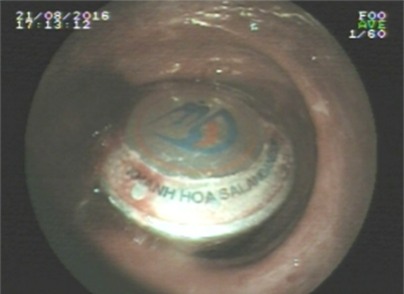 Lon nước yến nằm trong trực tràng bệnh nhân. Ảnh chụp qua nội soi.