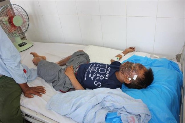 Be trai 14 tuoi nga vao bep lua, hong hoan toan mot ben mat