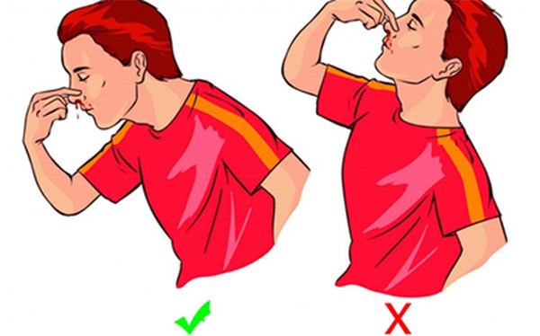 Chảy máu cam nên cúi đầu ra trước hay ngửa đầu ra sau mới đúng? - Ảnh 1.