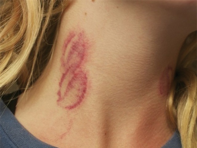 Không chỉ gây chết người, vết cắn yêu này còn chứa nhiều nguy cơ bất ngờ - Ảnh 3.