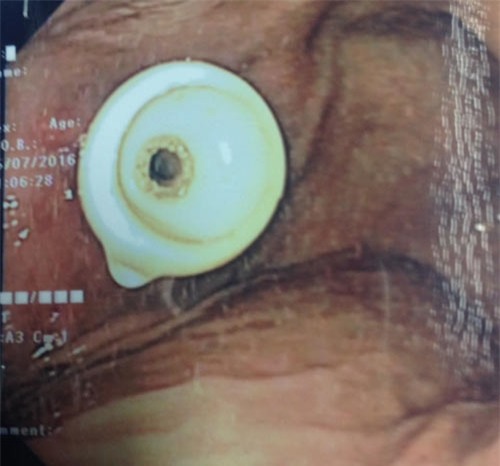 be 6 tuoi bi thung thuc quan do nuot do choi o nha tre hinh anh 1