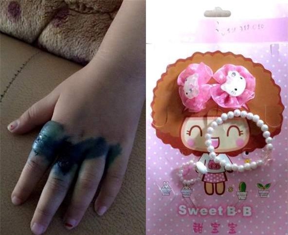 Tay phồng rộp nhiễm trùng nặng vì đeo nhẫn hạt nhựa Trung Quốc