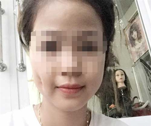 Mặt sưng vù vì làm má lúm đồng tiền giá rẻ - Ảnh 3.