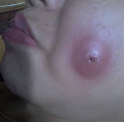 Mặt sưng vù vì làm má lúm đồng tiền giá rẻ - Ảnh 4.
