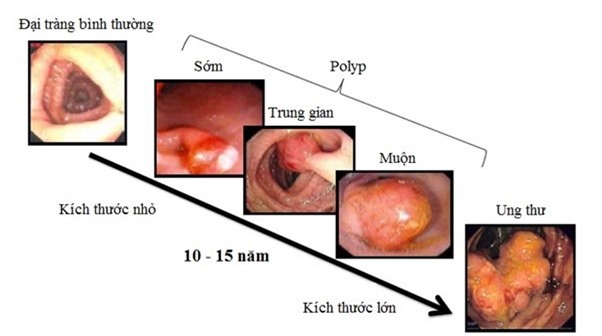 Chuyên gia chỉ đích danh thủ phạm gây ung thư trực tràng - Ảnh 2.