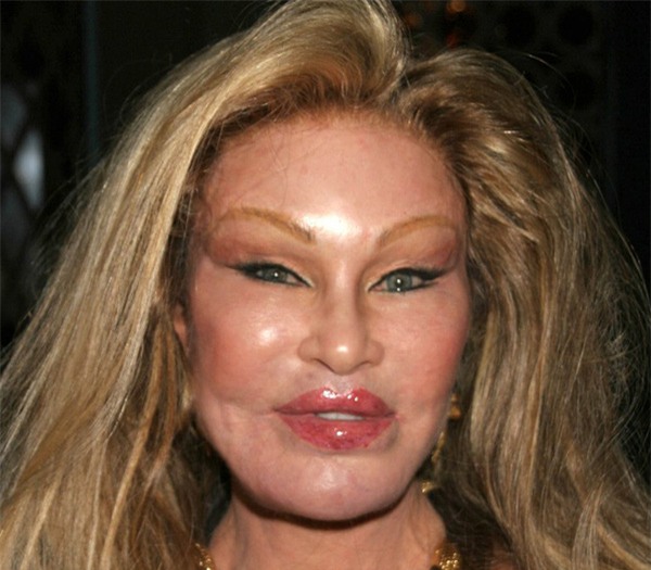 phương pháp tiêm môi