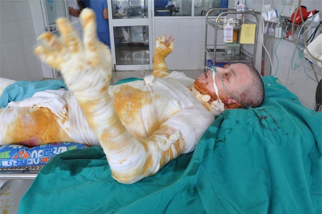Bị bỏng diện rộng lên đến 90% cơ thể trong đó hơn 60% bỏng sâu, ca bệnh của cháu Ân là 1 trong những ca nặng nhất .