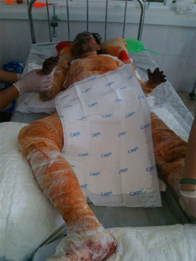 Xót thương cô gái xinh đẹp bị bỏng toàn thân, khuôn mặt biến dạng sau tai nạn - Ảnh 2.