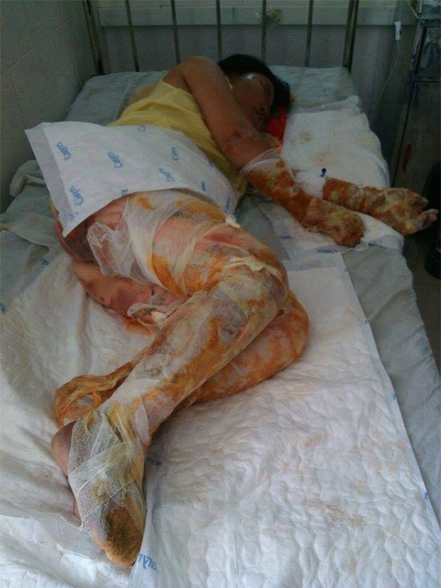 Xót thương cô gái xinh đẹp bị bỏng toàn thân, khuôn mặt biến dạng sau tai nạn - Ảnh 3.