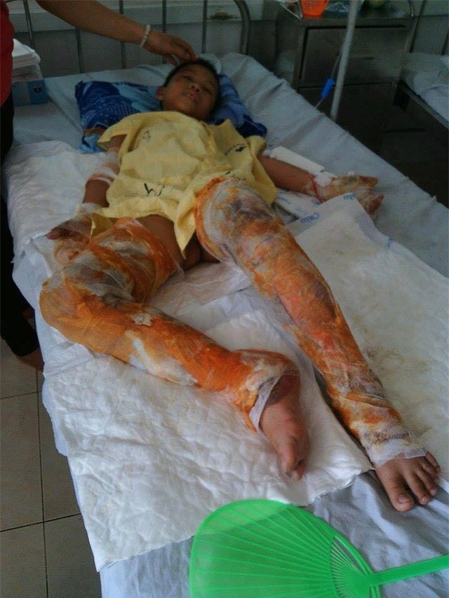 Xót thương cô gái xinh đẹp bị bỏng toàn thân, khuôn mặt biến dạng sau tai nạn - Ảnh 4.