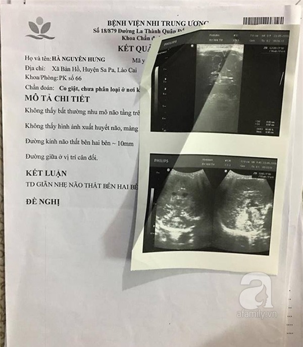 bại não