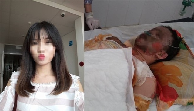 Ca lang thay phien nhau cham me con co gai bi bong toan than hinh anh 2