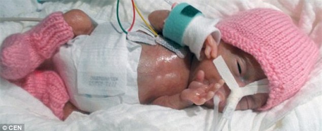 Kỳ tích sống sót của bé sơ sinh nhỏ nhất thế giới, nặng 220g với kích thước chỉ bằng 2 bàn tay - Ảnh 2.