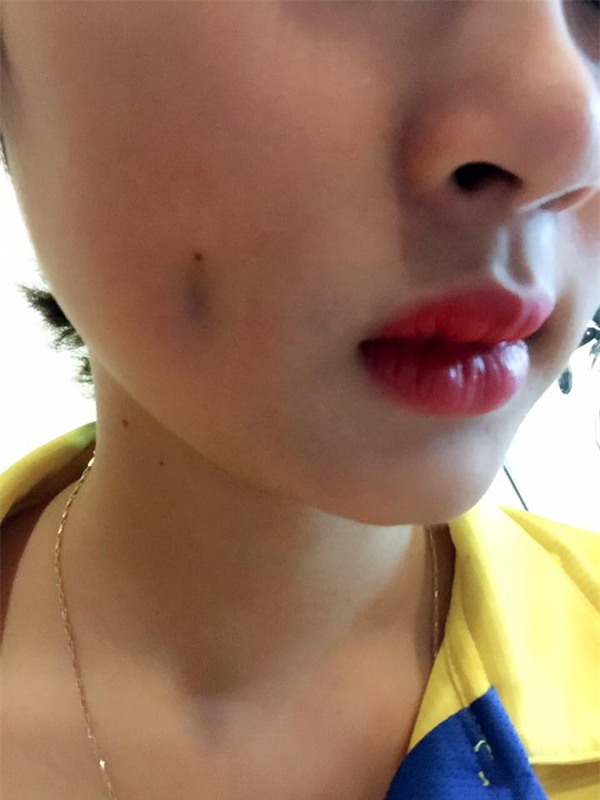 cô gái trẻ thẩm mỹ má lúm bị hỏng
