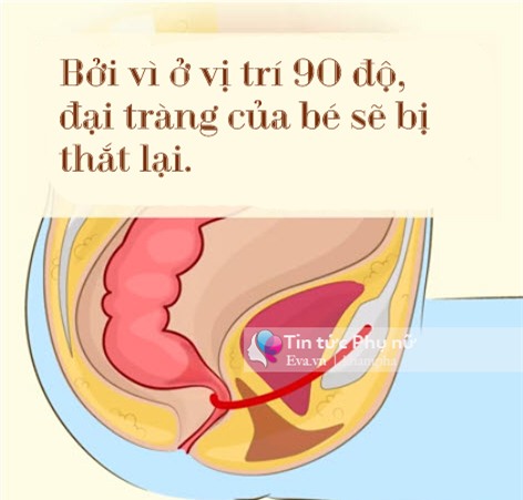 chi vi chiec bon cau, con co nguy co bi ung thu dai trang - 5