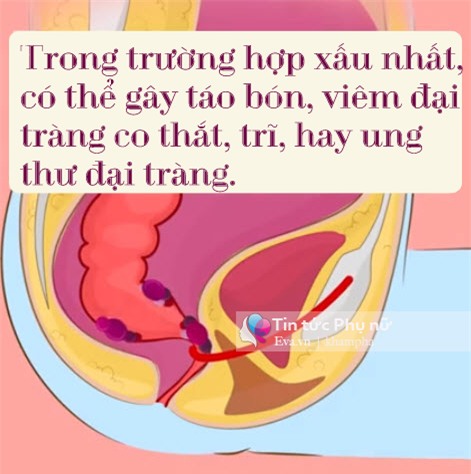 chi vi chiec bon cau, con co nguy co bi ung thu dai trang - 6