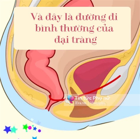 chi vi chiec bon cau, con co nguy co bi ung thu dai trang - 9