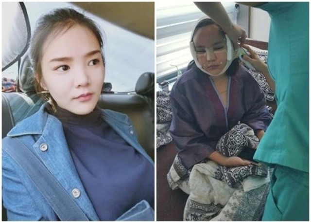 Sang Hàn phẫu thuật thẩm mỹ làm hot girl, 4 cô gái Thái tự tin khoe ảnh băng bó đầy đầu - Ảnh 1.