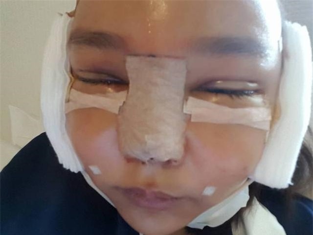 Sang Hàn phẫu thuật thẩm mỹ làm hot girl, 4 cô gái Thái tự tin khoe ảnh băng bó đầy đầu - Ảnh 8.