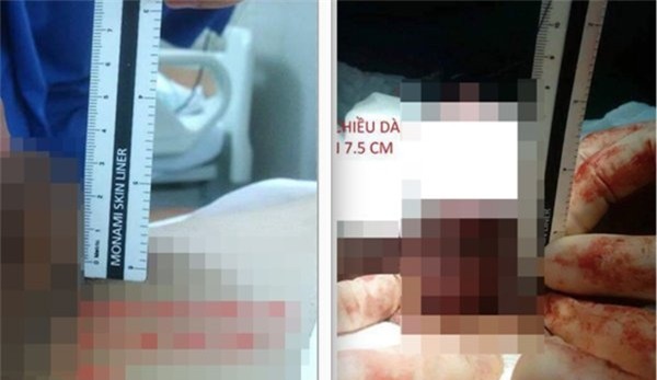 phẫu thuật kéo dài cậu nhỏ, nam học, của quý