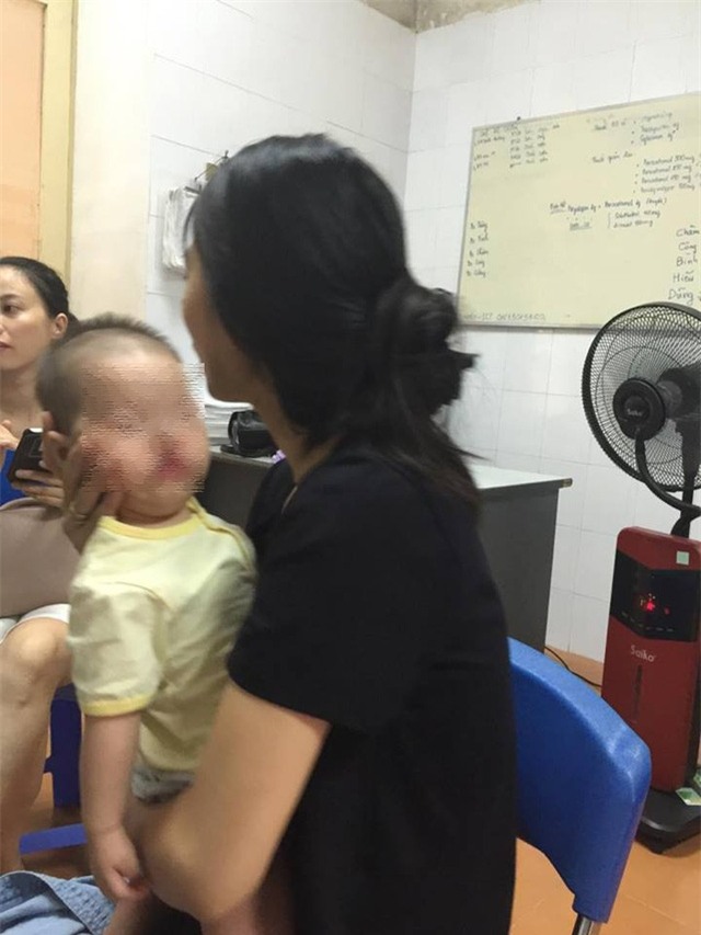 Bé V.M đang điều trị tại khoa Phẫu thuật, tạo hình hàm mặt, bệnh viện Việt Nam Cu Ba. Ảnh: Võ Thu