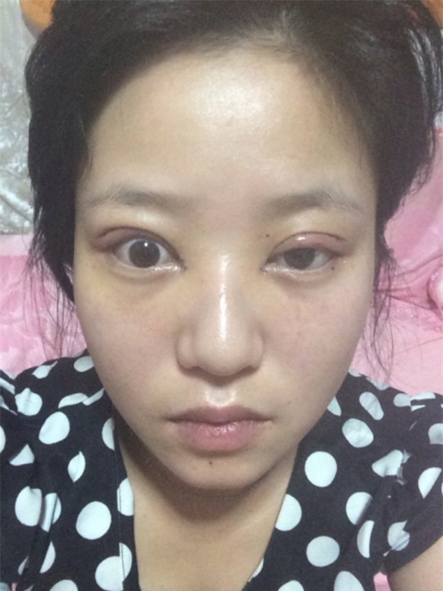 Ham đẹp như gái Hàn, nhiều phụ nữ Trung Quốc ôm hận thiên thu vì phẫu thuật thẩm mỹ hỏng - Ảnh 5.