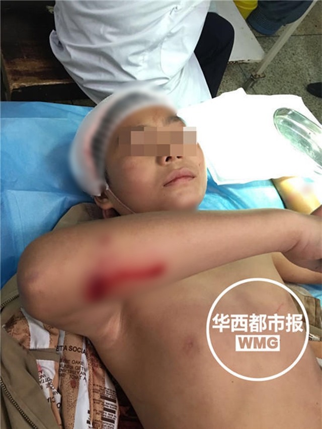 Đang trên đường đi học về, bé trai 12 tuổi bị đàn khỉ hoang xúm vào tấn công trọng thương - Ảnh 2.