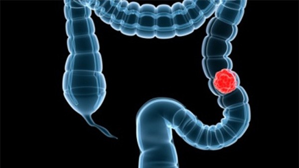 ung thư ruột ở người gầy