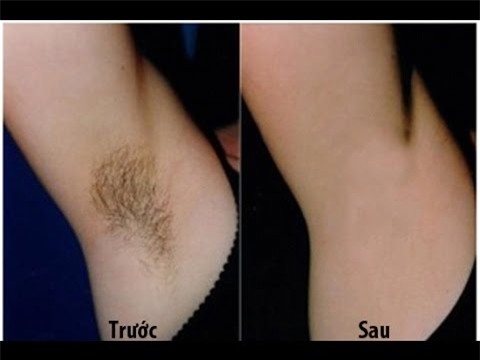 Long nach bien mat vinh vien trong 2 phut khong can nhip