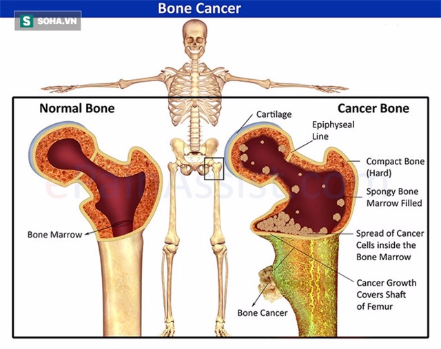 Những triệu chứng cảnh báo bệnh ung thư xương cần đi khám ngay - Ảnh 1.