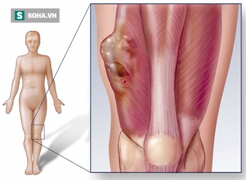 Những triệu chứng cảnh báo bệnh ung thư xương cần đi khám ngay - Ảnh 2.