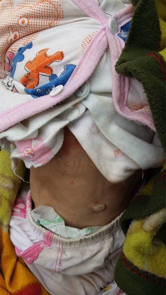 Sau hơn 3 tháng được mẹ nuôi chăm sóc, bé gái 14 tháng tuổi nặng 3,5kg giờ ra sao?