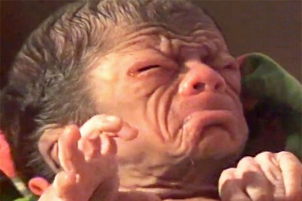 Em bé bị bệnh lạ, Em bé già như lão 80, em bé mắc bệnh lão hóa