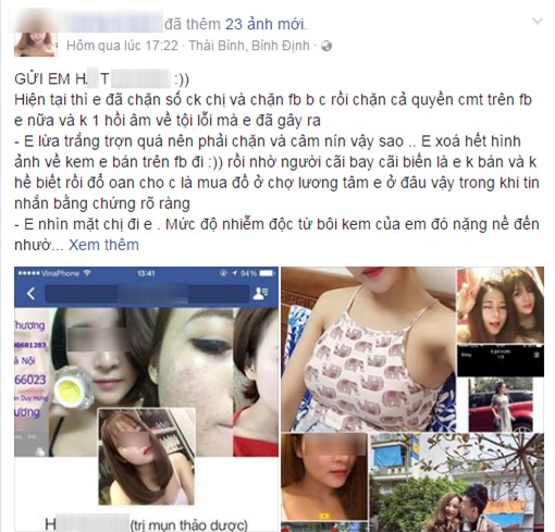 cô gái biến dạng mặt vì kem giả