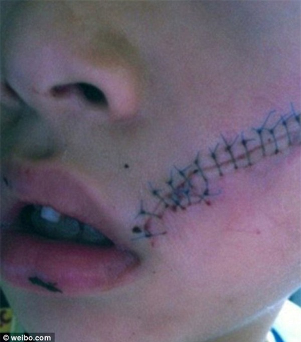 be trai bi khau 38 mui tren mat chi vi lon nuoc ngot 'phat no' - 1