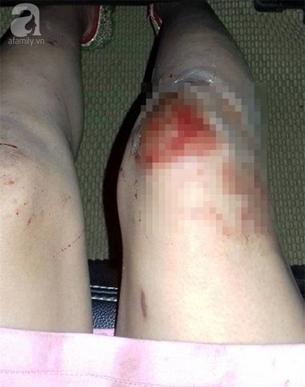 Gương mặt bê bết máu của người vợ trẻ đẹp tố chồng nghiện ngập, đánh đập thậm tệ đến dập mũi, dãy xương sườn