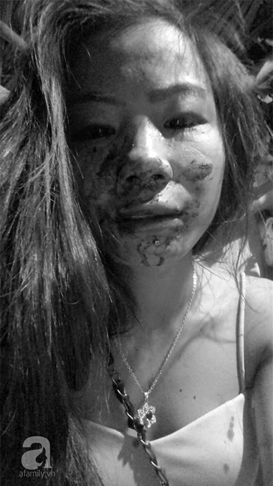 Gương mặt bê bết máu của người vợ trẻ đẹp tố chồng nghiện ngập, đánh đập thậm tệ đến dập mũi, dãy xương sườn