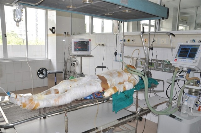 Em Nghĩa bị bỏng 63%, trong đó có 34% bỏng sâu độ 2,3,4 mặt, thân chi, bỏng hô hấp rất nặng.