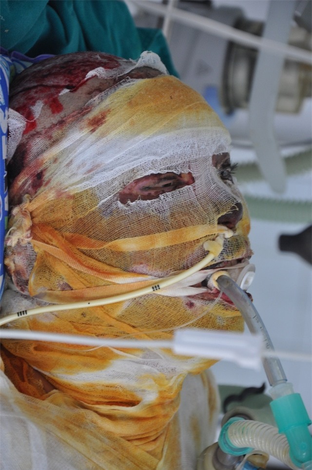 Hiện em đang trong tình trạng sốc bỏng nặng với chi phí điều trị tốn kém.