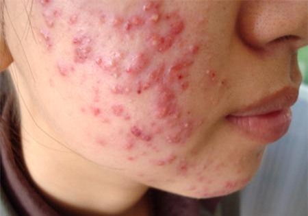 dưỡng da, làm đẹp, làm trắng da, bệnh ngoài da, kem trộn, dị ứng kem trộn